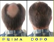 protesi capillare 100% Human Hair _uomo_ prima-dopo